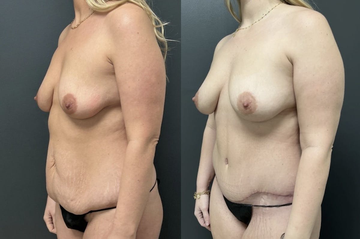Abdominoplasty (Tummy Tuck) Before & After Gallery - Patient 231921 - Image 2