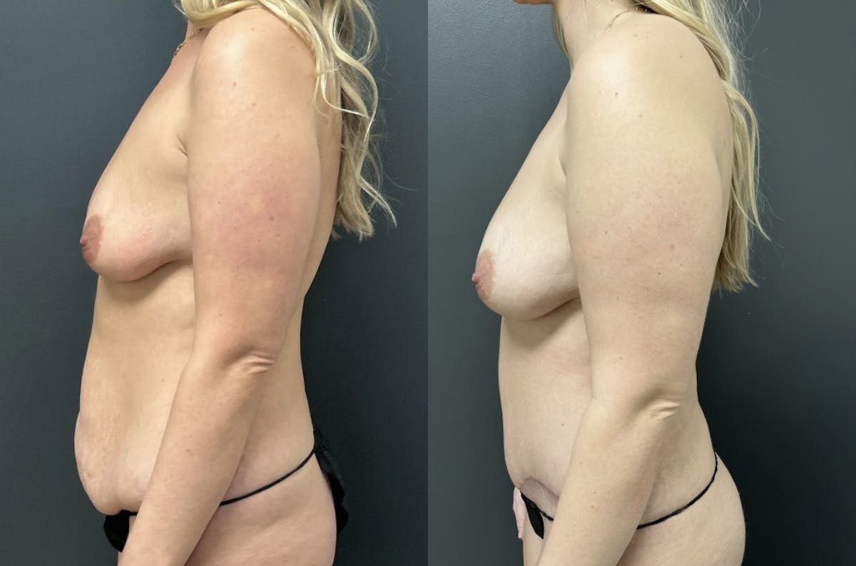 Abdominoplasty (Tummy Tuck) Before & After Gallery - Patient 231921 - Image 3