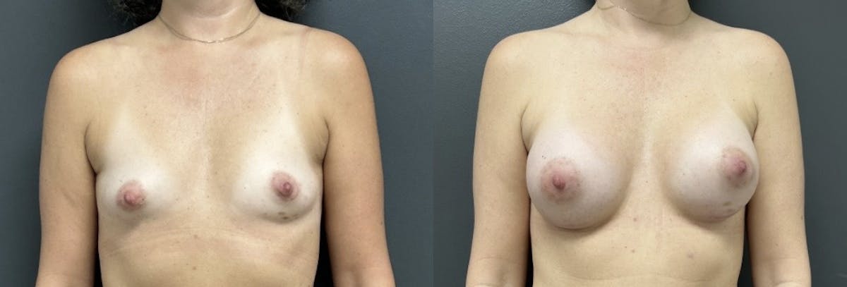 Breast Augmentation Before & After Gallery - Patient 226741 - Image 1