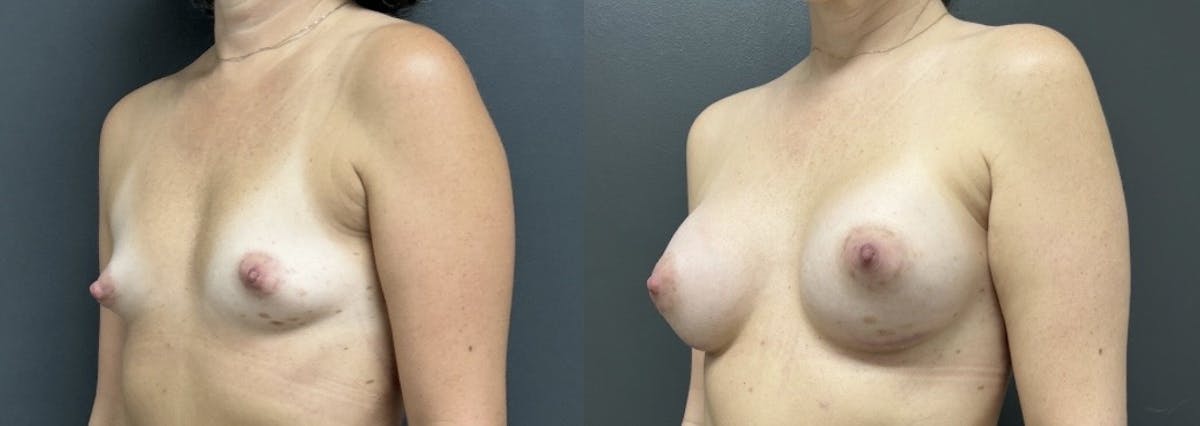 Breast Augmentation Before & After Gallery - Patient 226741 - Image 2