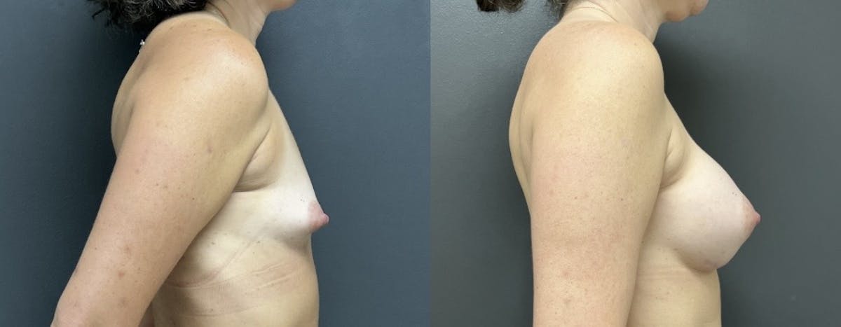 Breast Augmentation Before & After Gallery - Patient 226741 - Image 3