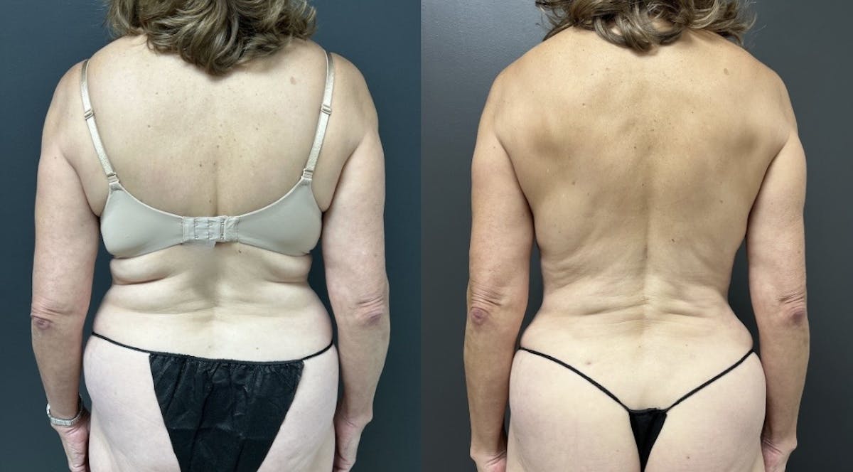 Liposuction Before & After Gallery - Patient 242870 - Image 1