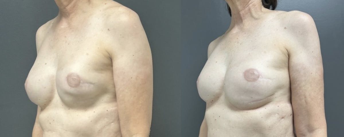 Breast Reconstruction Before & After Gallery - Patient 650739 - Image 2