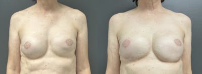 Breast Reconstruction Before & After Gallery - Patient 650739 - Image 1