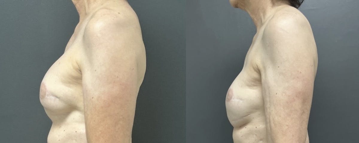 Breast Reconstruction Before & After Gallery - Patient 650739 - Image 3