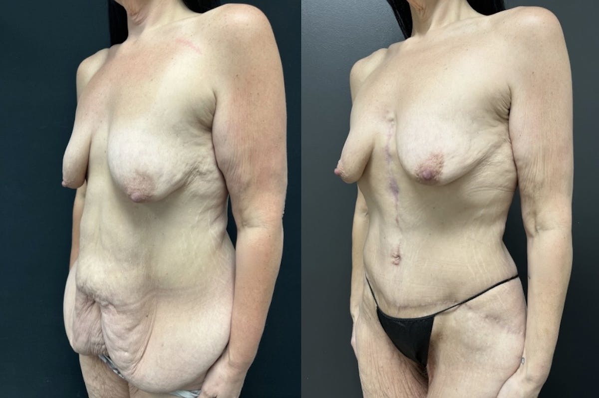 Fleur De Lis Abdominoplasty Before & After Gallery - Patient 318674 - Image 2