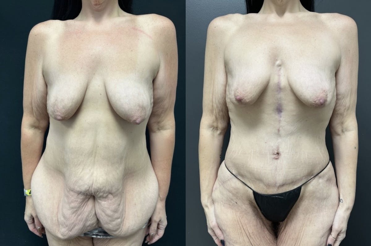 Fleur De Lis Abdominoplasty Before & After Gallery - Patient 318674 - Image 1