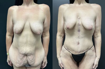 Fleur De Lis Abdominoplasty Before & After Gallery - Patient 318674 - Image 1