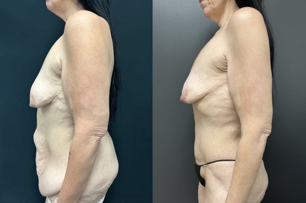 Fleur De Lis Abdominoplasty Before & After Gallery - Patient 318674 - Image 3