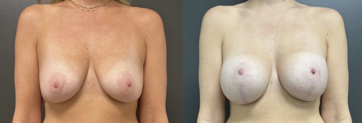 Breast Augmentation with Lift Before & After Gallery - Patient 320456 - Image 1