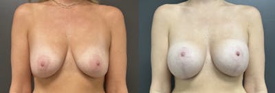 Breast Augmentation with Lift Before & After Gallery - Patient 320456 - Image 1