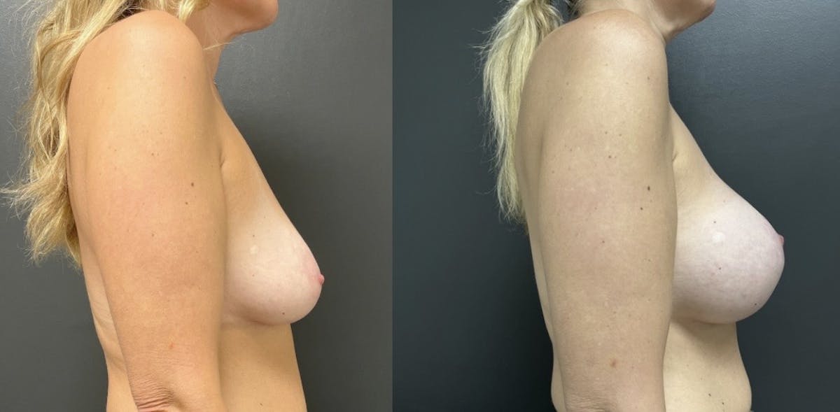 Breast Augmentation with Lift Before & After Gallery - Patient 320456 - Image 3
