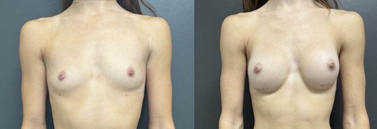 Breast Augmentation with Lift Before & After Gallery - Patient 186875 - Image 1