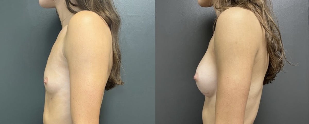 Breast Augmentation with Lift Before & After Gallery - Patient 186875 - Image 3