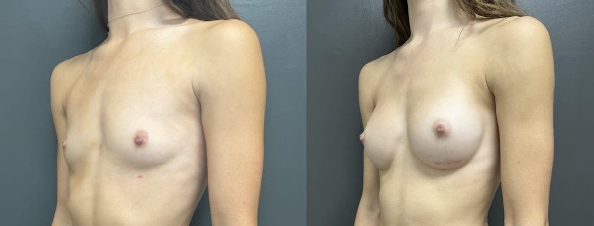 Breast Augmentation with Lift Before & After Gallery - Patient 186875 - Image 2