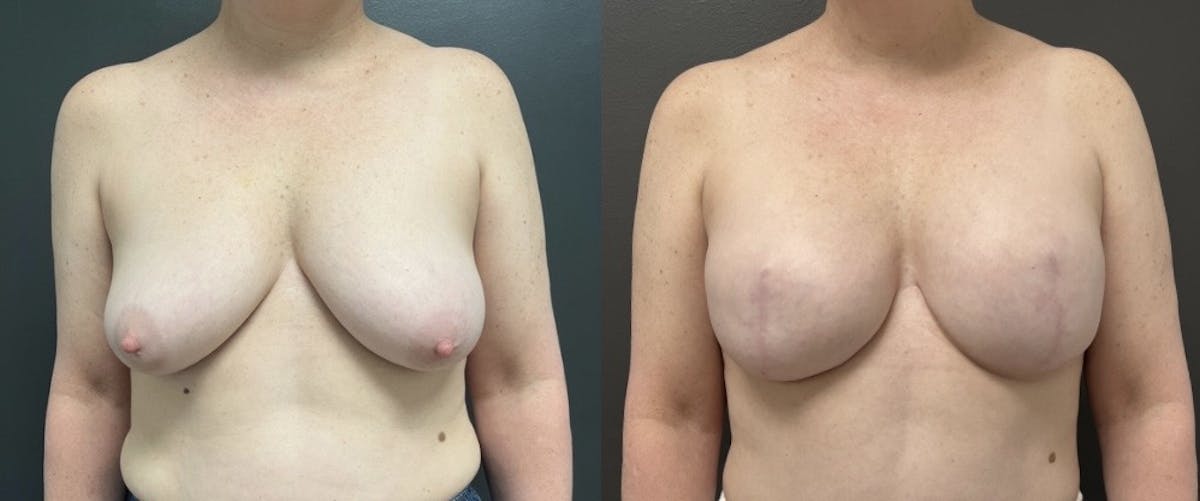 Breast Reconstruction Before & After Gallery - Patient 248689 - Image 1