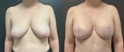 Breast Reconstruction Before & After Gallery - Patient 248689 - Image 1