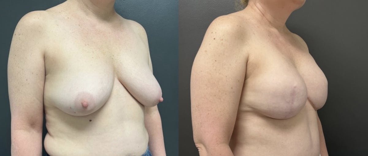 Breast Reconstruction Before & After Gallery - Patient 248689 - Image 2