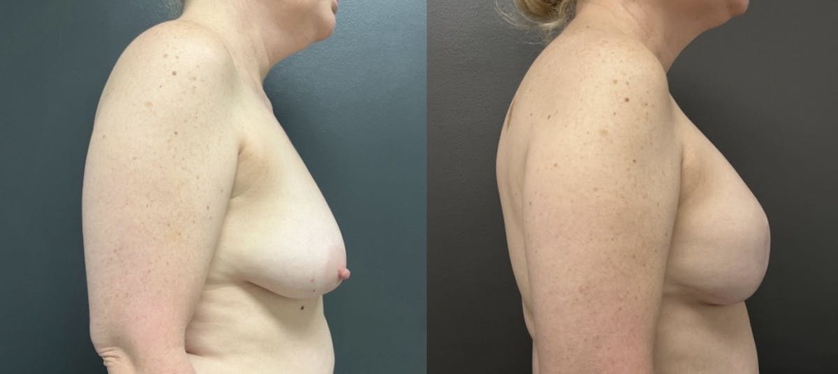 Breast Reconstruction Before & After Gallery - Patient 248689 - Image 3