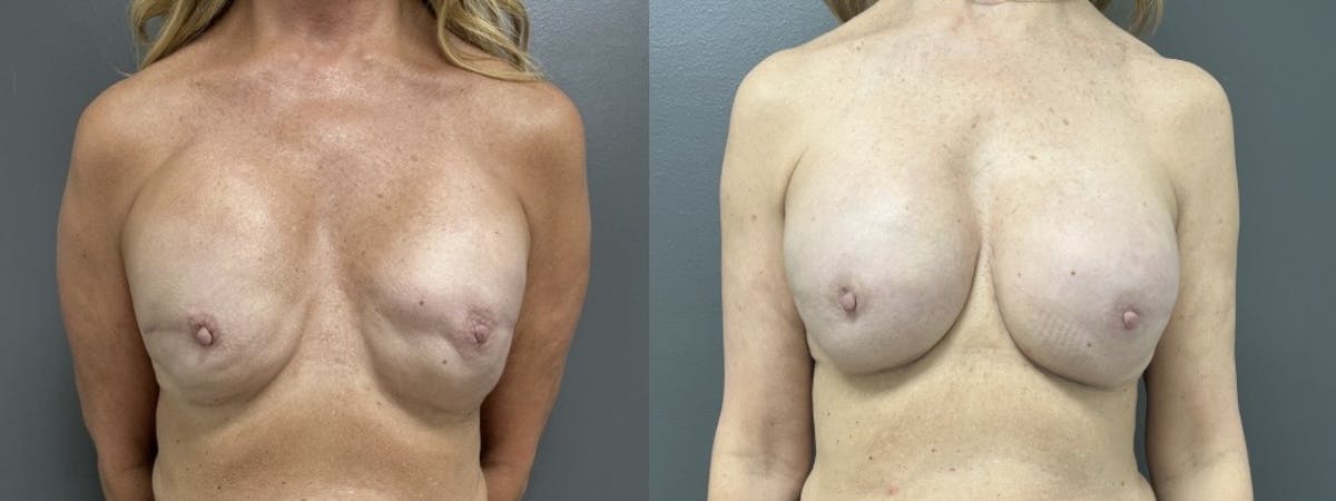 Breast Reconstruction Before & After Gallery - Patient 241373 - Image 1