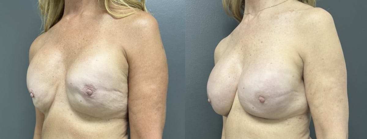 Breast Reconstruction Before & After Gallery - Patient 241373 - Image 2