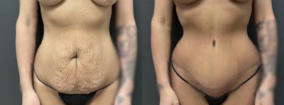 Abdominoplasty (Tummy Tuck) Before & After Gallery - Patient 357703 - Image 1