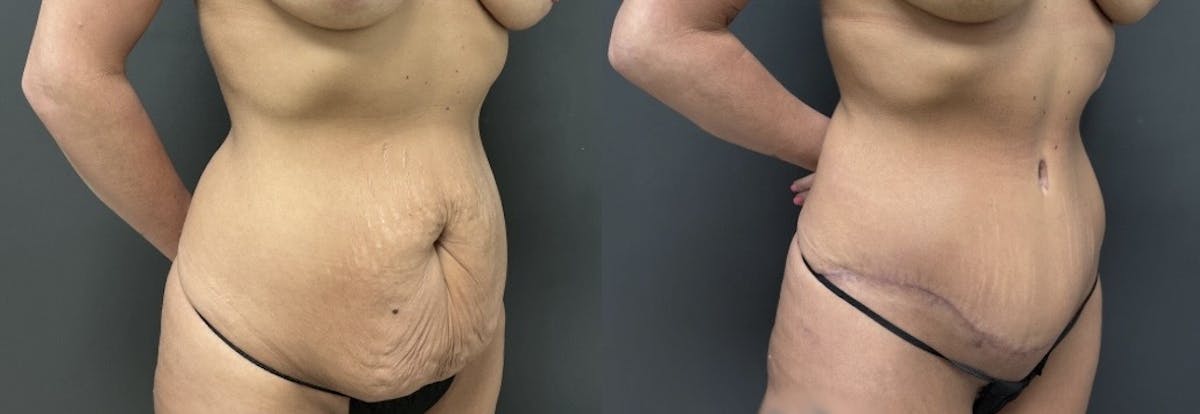 Abdominoplasty (Tummy Tuck) Before & After Gallery - Patient 357703 - Image 2