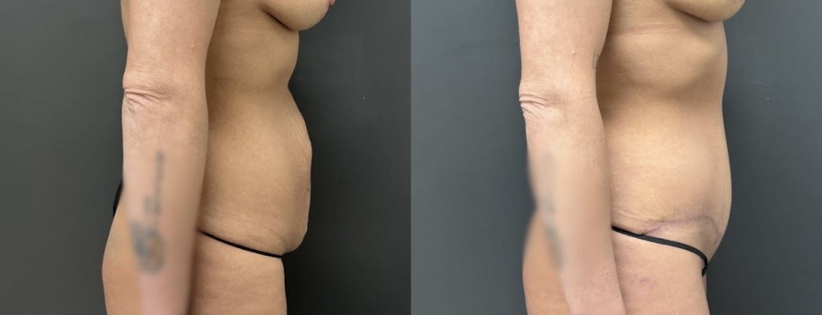 Abdominoplasty (Tummy Tuck) Before & After Gallery - Patient 357703 - Image 3