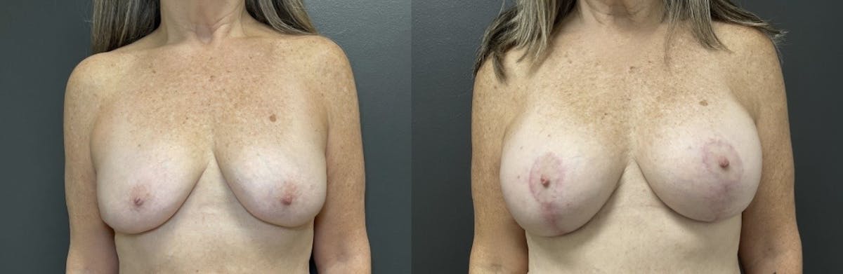 Breast Augmentation with Lift Before & After Gallery - Patient 219966 - Image 1