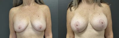 Breast Augmentation with Lift Before & After Gallery - Patient 219966 - Image 1
