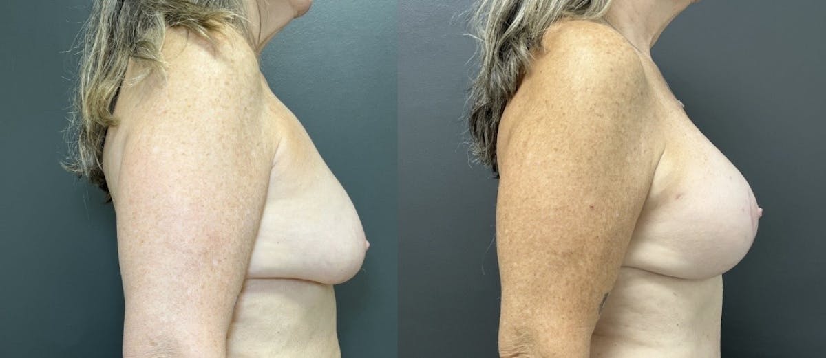 Breast Augmentation with Lift Before & After Gallery - Patient 219966 - Image 3