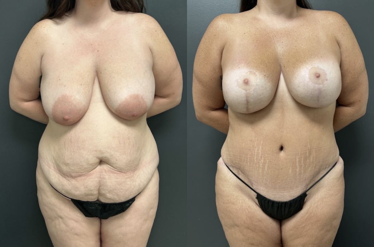 Abdominoplasty (Tummy Tuck) Before & After Gallery - Patient 141755 - Image 1