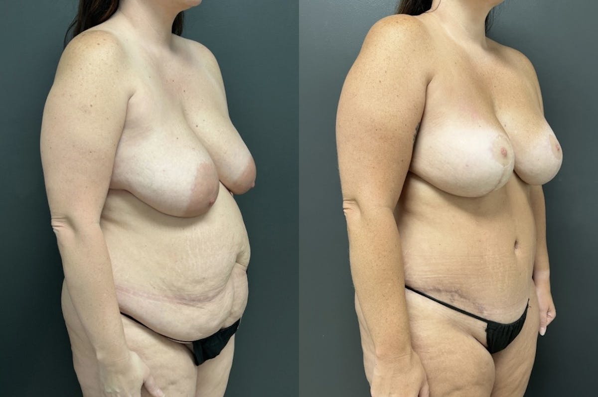 Abdominoplasty (Tummy Tuck) Before & After Gallery - Patient 141755 - Image 2