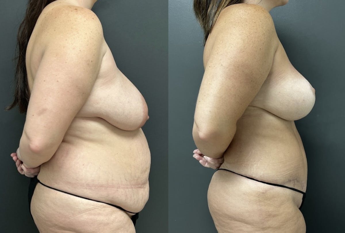 Abdominoplasty (Tummy Tuck) Before & After Gallery - Patient 141755 - Image 3
