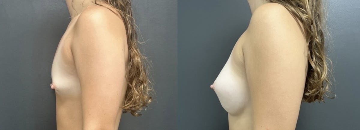 Breast Augmentation Before & After Gallery - Patient 809964 - Image 3