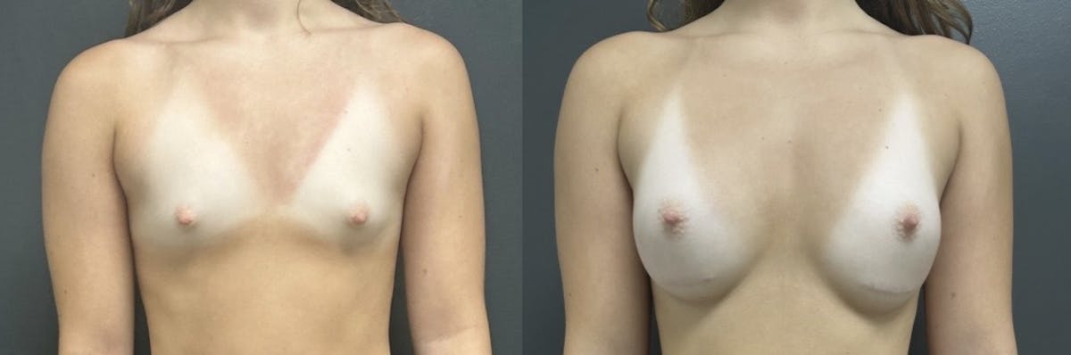 Breast Augmentation Before & After Gallery - Patient 809964 - Image 1