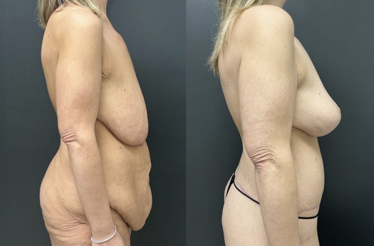 Fleur De Lis Abdominoplasty Before & After Gallery - Patient 390829 - Image 3