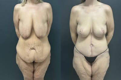Fleur De Lis Abdominoplasty Before & After Gallery - Patient 390829 - Image 1