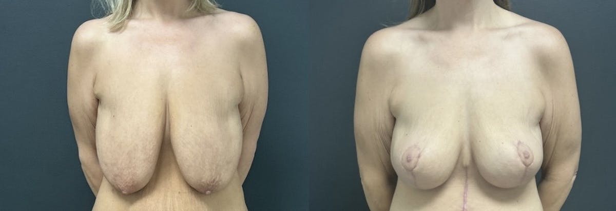 Mastopexy (Breast Lift) Before & After Gallery - Patient 346171 - Image 1