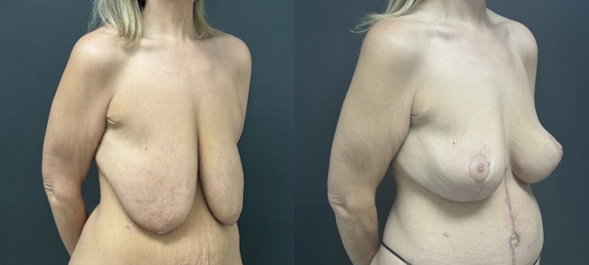 Mastopexy (Breast Lift) Before & After Gallery - Patient 346171 - Image 2