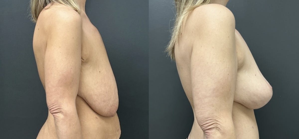 Mastopexy (Breast Lift) Before & After Gallery - Patient 346171 - Image 3