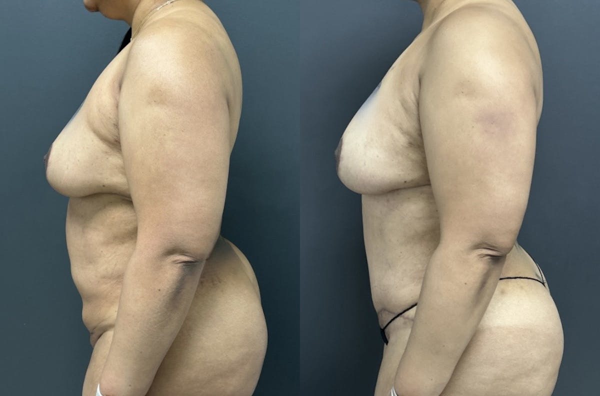 Abdominoplasty (Tummy Tuck) Before & After Gallery - Patient 274432 - Image 3