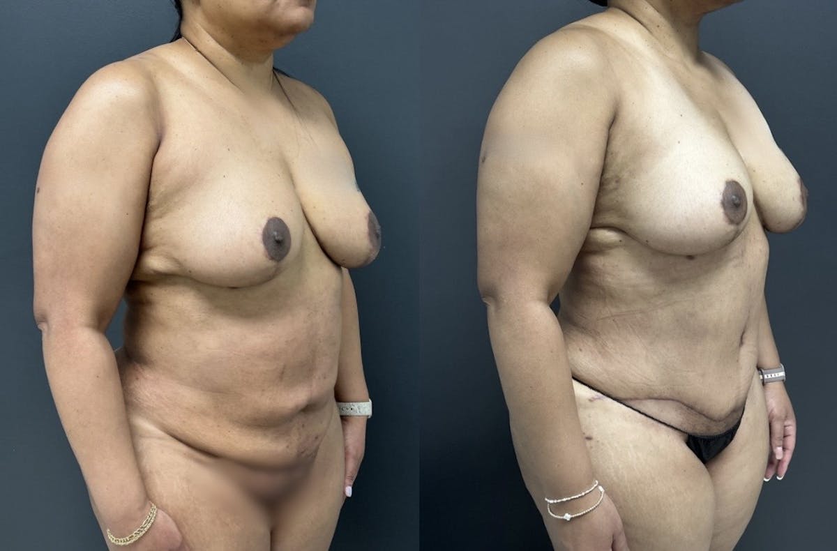 Abdominoplasty (Tummy Tuck) Before & After Gallery - Patient 274432 - Image 2