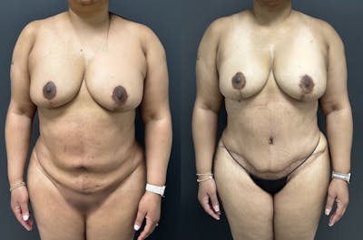 Abdominoplasty (Tummy Tuck) Before & After Gallery - Patient 274432 - Image 1