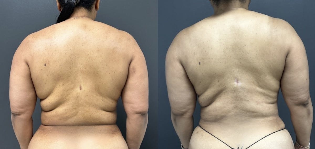 Liposuction Before & After Gallery - Patient 426293 - Image 1