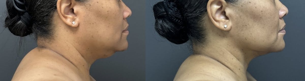 Submental Liposuction Before & After Gallery - Patient 181992 - Image 1