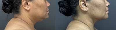 Submental Liposuction Before & After Gallery - Patient 181992 - Image 1