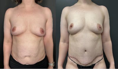 Abdominoplasty (Tummy Tuck) Before & After Gallery - Patient 368192 - Image 1