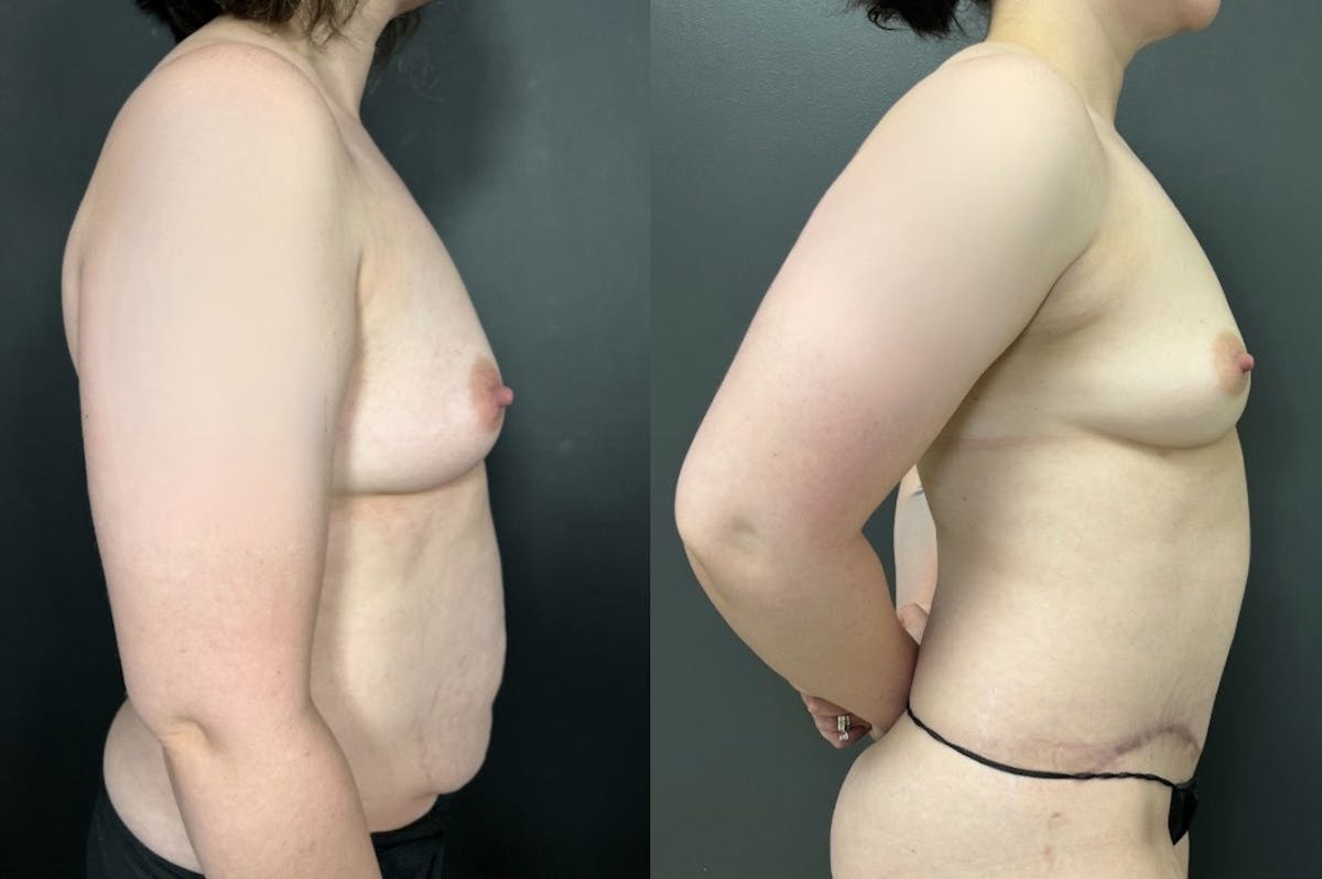Abdominoplasty (Tummy Tuck) Before & After Gallery - Patient 368192 - Image 2