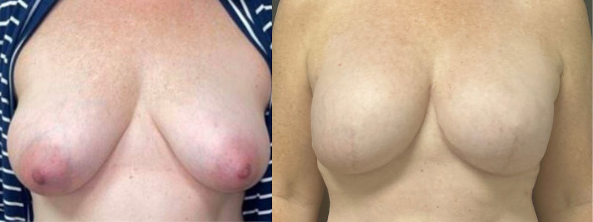 Breast Reconstruction Before & After Gallery - Patient 749061 - Image 1